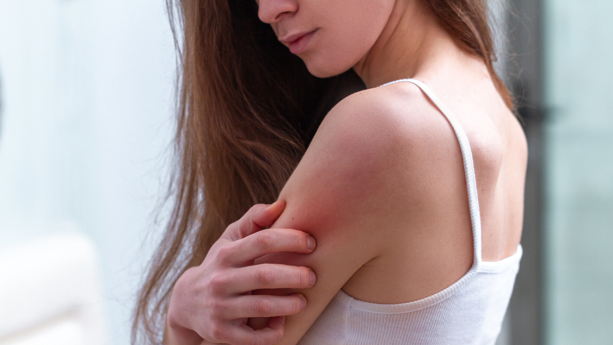 Woman with atopic skin on her arm Woman with eczema scratching her arm